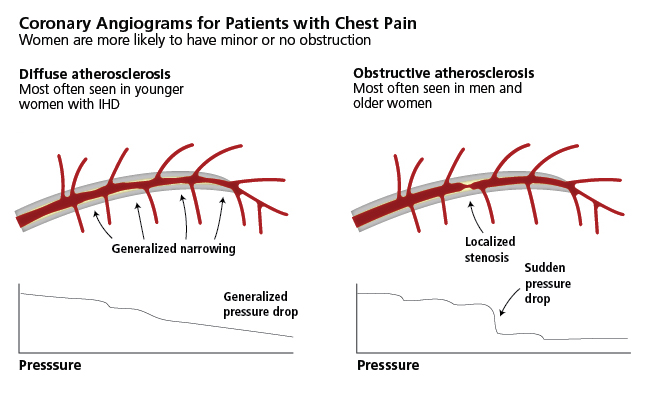 coronary Angiograms for pts with chest pain