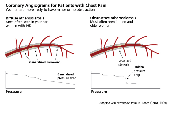 coronary Angiograms for patients with chest pain